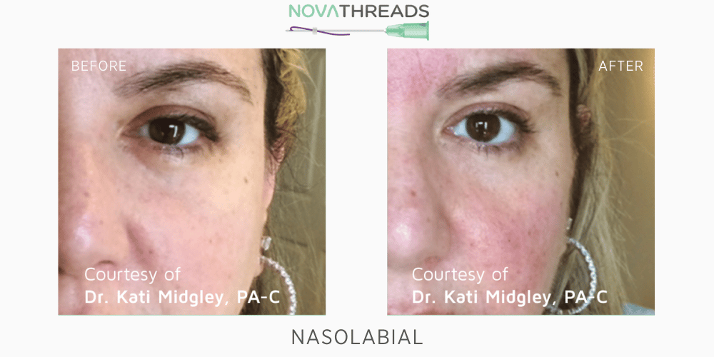 PDO Threads  Non-Surgical Facelift with NOVA Threads in Utah