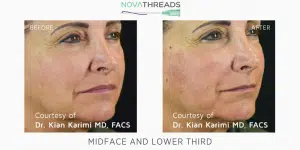 novathread before and after