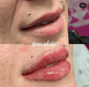 art of aesthetics-before and after-dermal-1