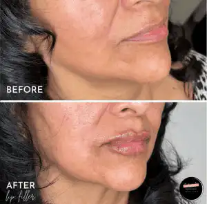 art of aesthetics-before and after-dermal-2