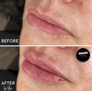 art of aesthetics-before and after-dermal-3
