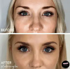 art of aesthetics-before and after-dermal-4