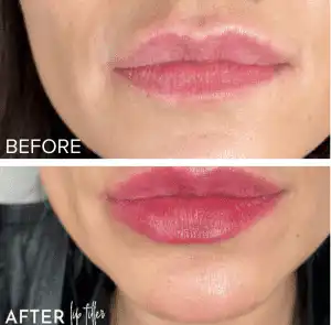 art of aesthetics-before and after-dermal-6