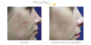Inspire Medspa-micropen evo before and after-1