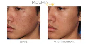 Inspire Medspa-micropen evo before and after-2