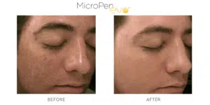 Inspire Medspa-micropen evo before and after-3