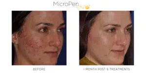 Inspire Medspa-micropen evo before and after-4
