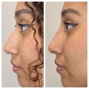 liquid rhinoplasty before and after image - inspire medical spa