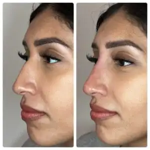liquid rhinoplasty before and after image - inspiremedicalspas