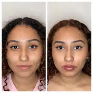 liquid rhinoplasty before and after - inspire medical spa