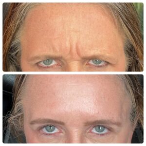 Botox before and after photos