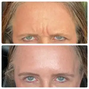 Blonde woman with one photo of wrinkles between her eye brows, and one photo without wrinkles, displaying her botox before and after results in South Jordan, UT.