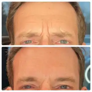 Man with one photo of wrinkles around his eyes, and one photo without wrinkles, displaying his botox before and after images in South Jordan, UT.
