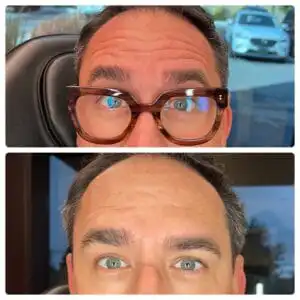 Picture of man with wrinkles before his Botox, and a picture of his wrinkles after Botox. He is displaying his before and after photos for Botox in South Jordan, UT.