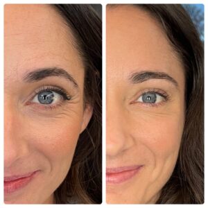Botox before and after photos