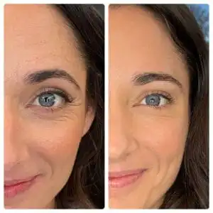 Brunette woman with one photo of wrinkles on her crow's feet, and one photo without wrinkles, displaying her botox before and after results in South Jordan, UT.