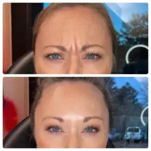 Woman with one photo of wrinkles between her eye brows, and one photo without wrinkles, displaying her botox before and after image results in South Jordan, UT.