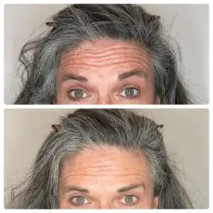 Gray haired woman with one photo of wrinkles on her forehead, and one photo without wrinkles, displaying her botox before and after images in South Jordan, UT.