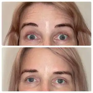 Blonde woman with one photo of wrinkles, and one photo without wrinkles, displaying her botox results in South Jordan, UT.