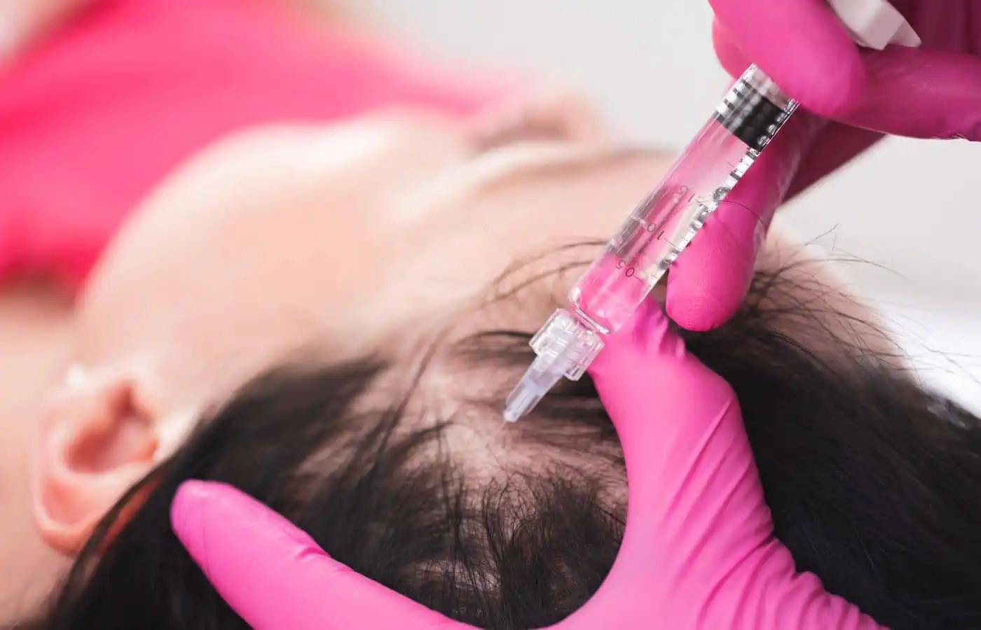 Woman receiving plasma injections into her hair for hair resotration in Utah.