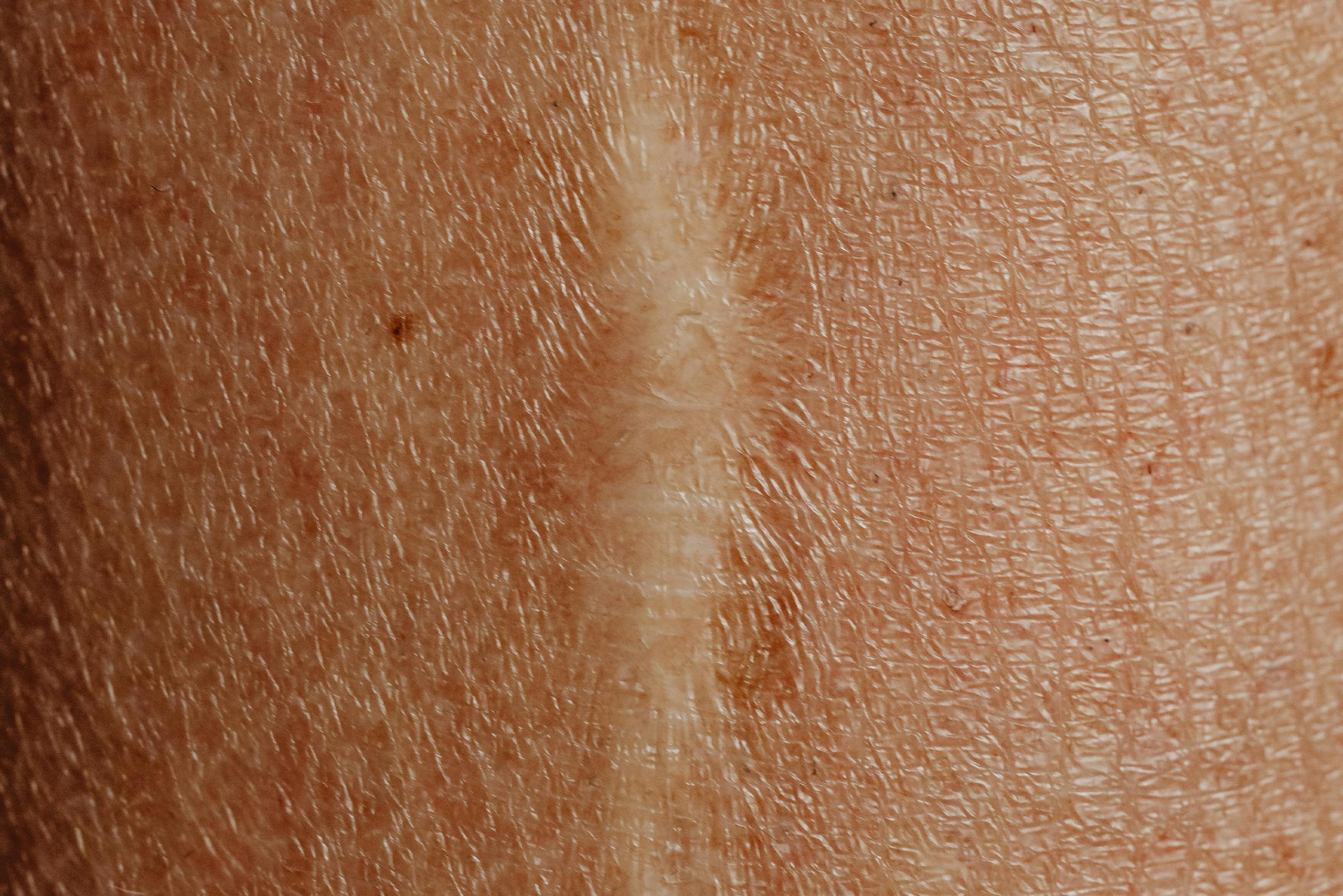 an image of a scar that is slowly healing