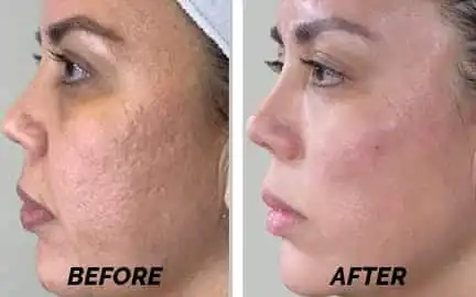 halo - 3 before after