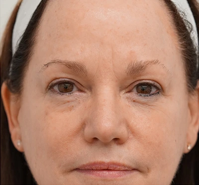 a woman with reduced fine lines and smother skin after Halo Laser Treatment