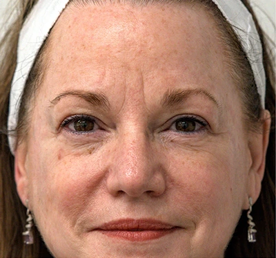 a woman with fine lines and wrinkles that needs Halo Laser Treatment