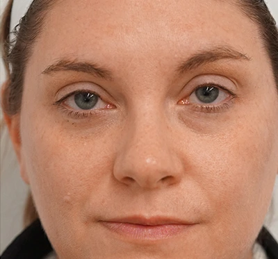 a woman with more even skin tone after Halo Laser Treatment