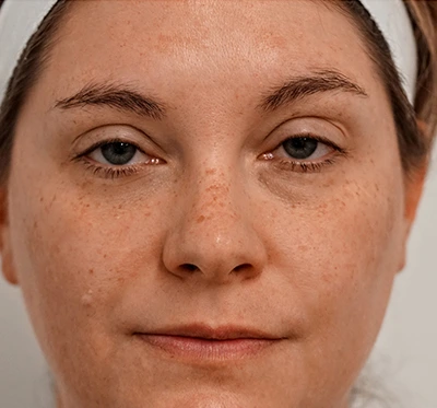 a woman with dark spots and needs halo laser tratment
