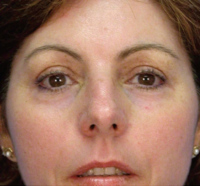 a woman with minimized sun damage after Halo Laser Treatment