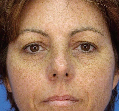 a woman with sun damage and needs halo laser tratment