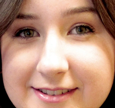 a woman with healed acne scars after halo laser tratment