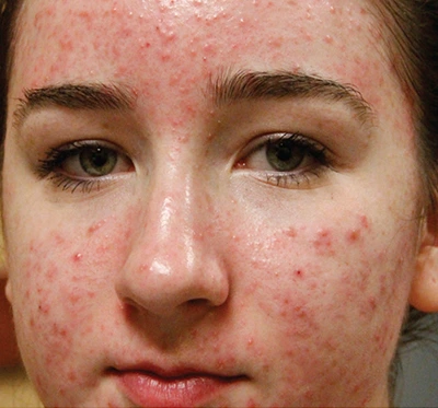 a woman with acne scars and needs halo laser tratment