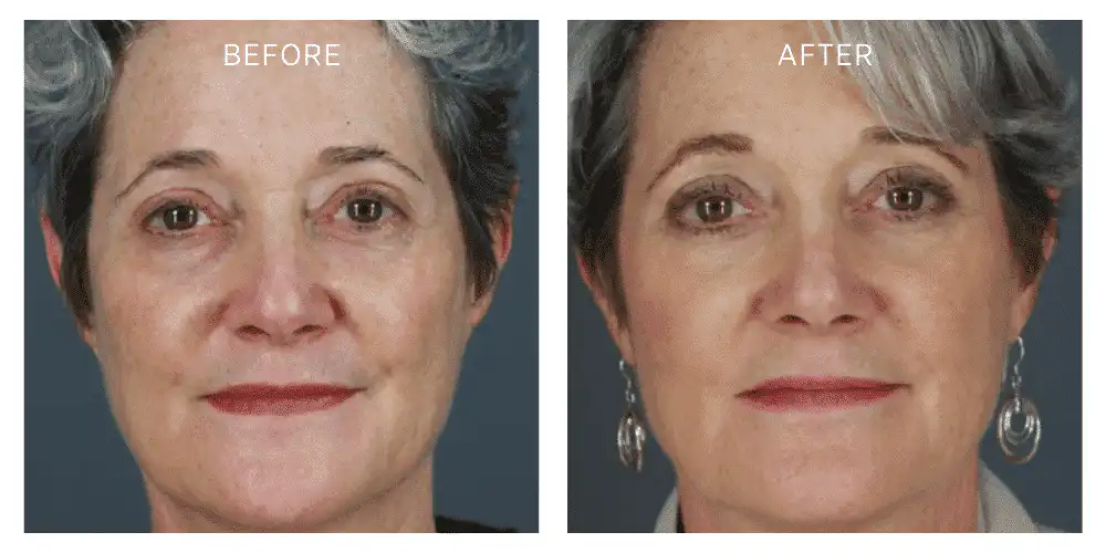 plasma-injections-before-and-after-result-one