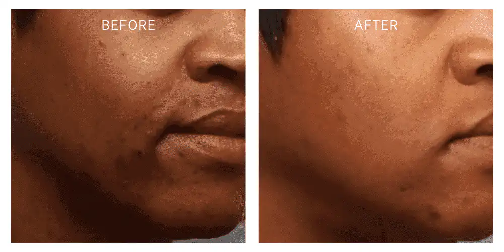 plasma-injections-before-and-after-result-two