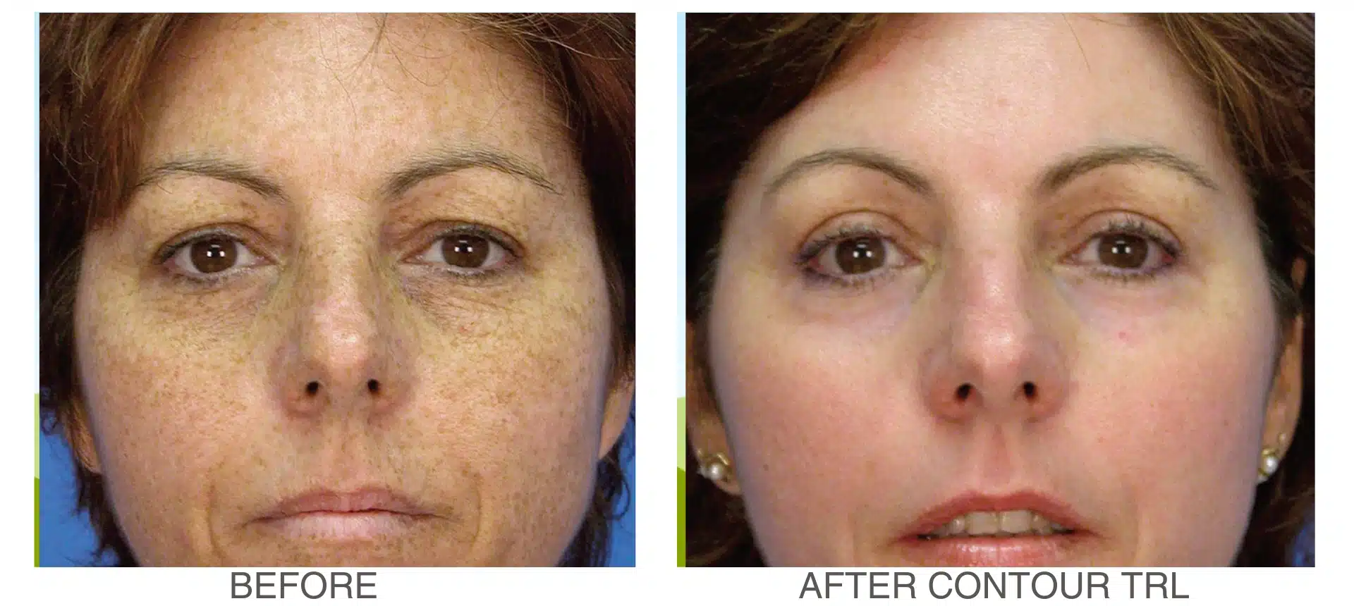 before-and-after-contour-trl-results