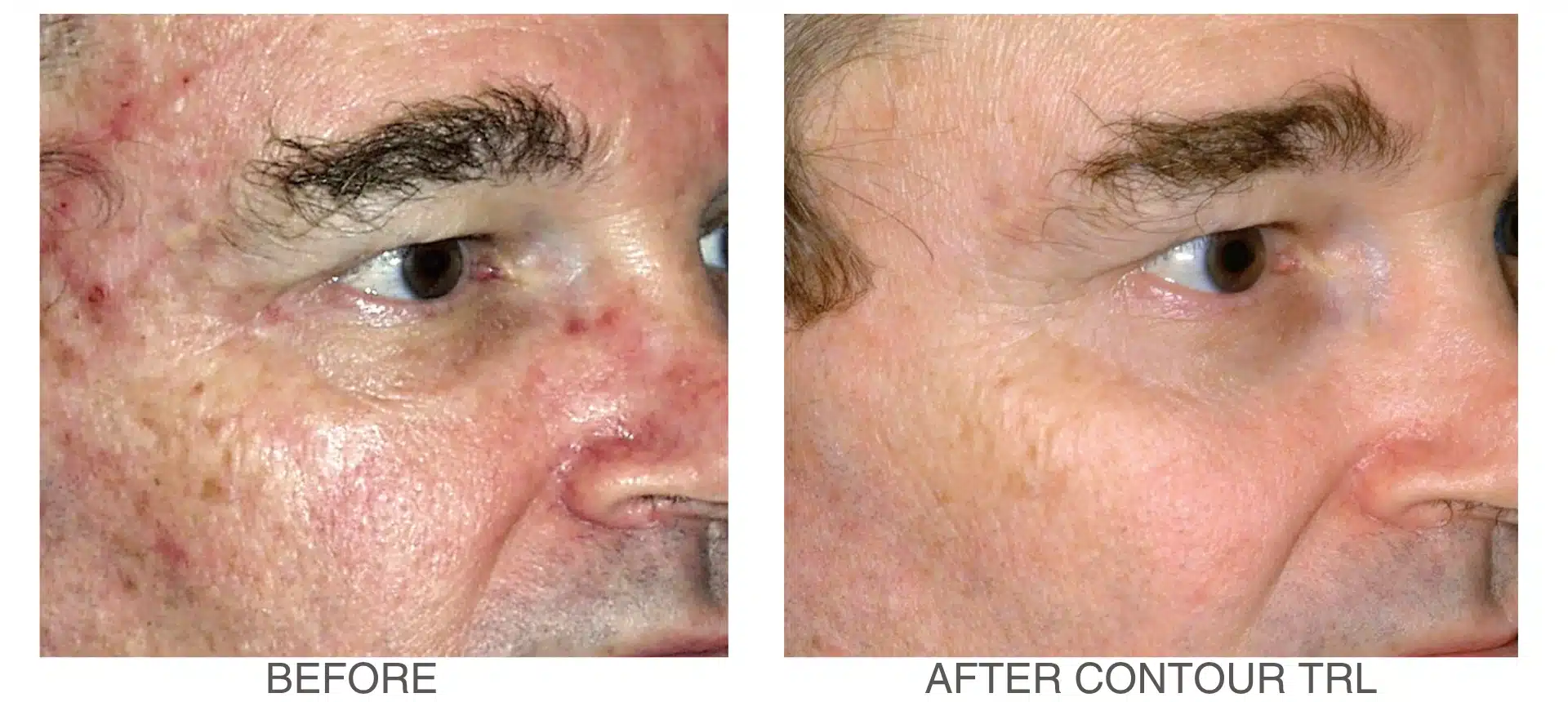before-and-after-contour-trl