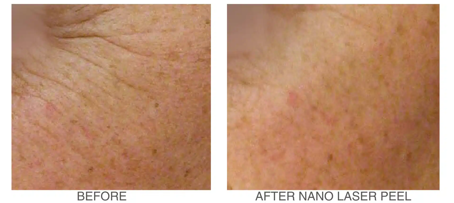 before-and-after-nano-laser-peel-results