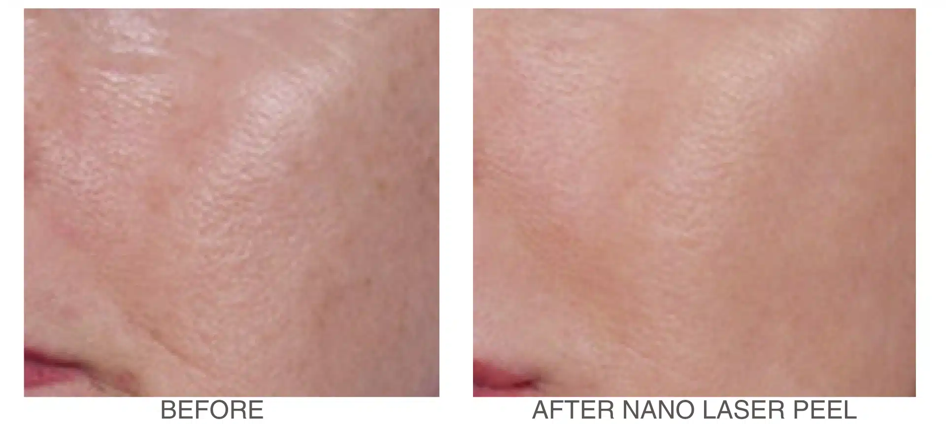before-and-after-nano-laser-peel