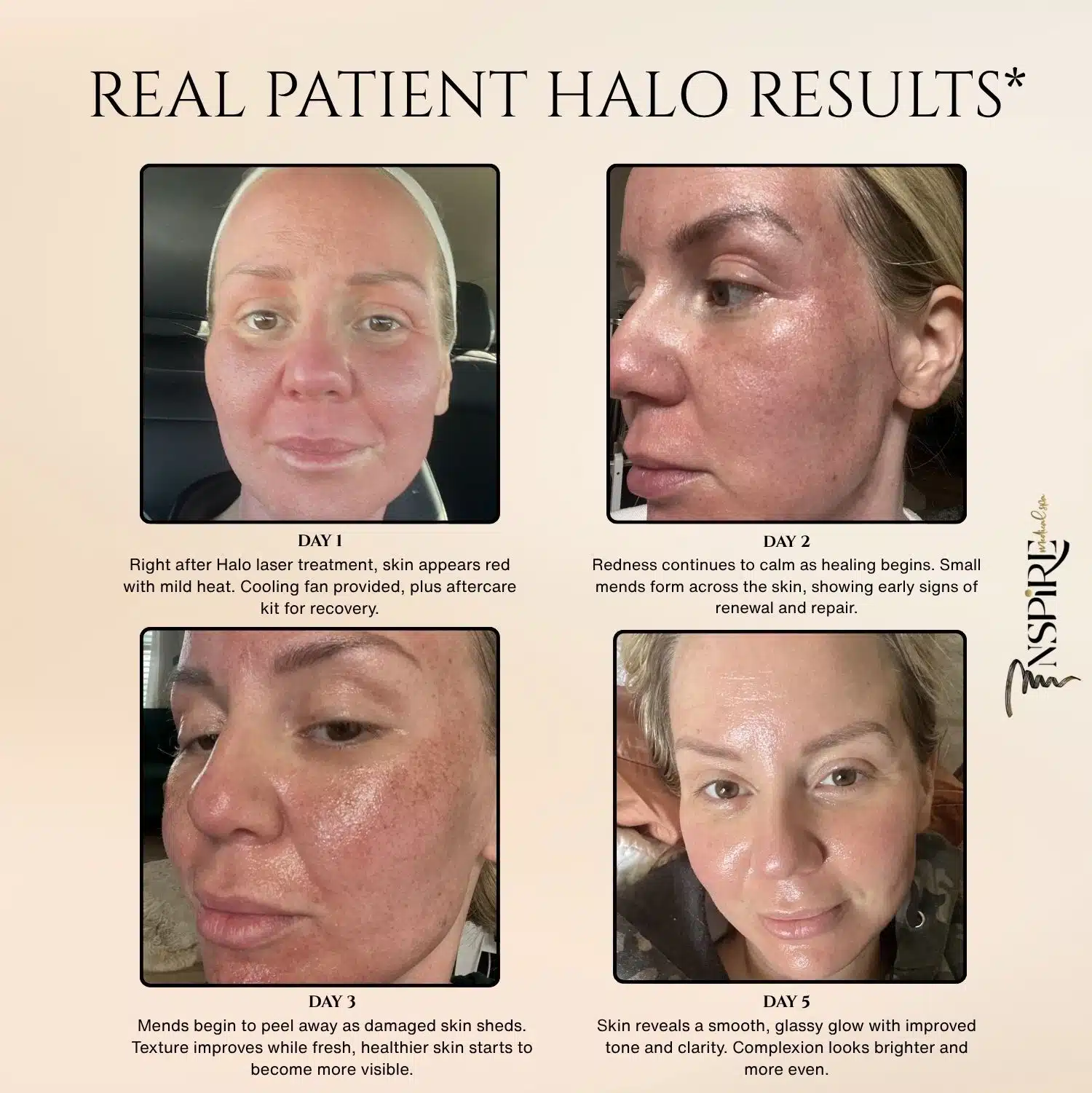 halo-laser-skin-resurfacing-results-utah