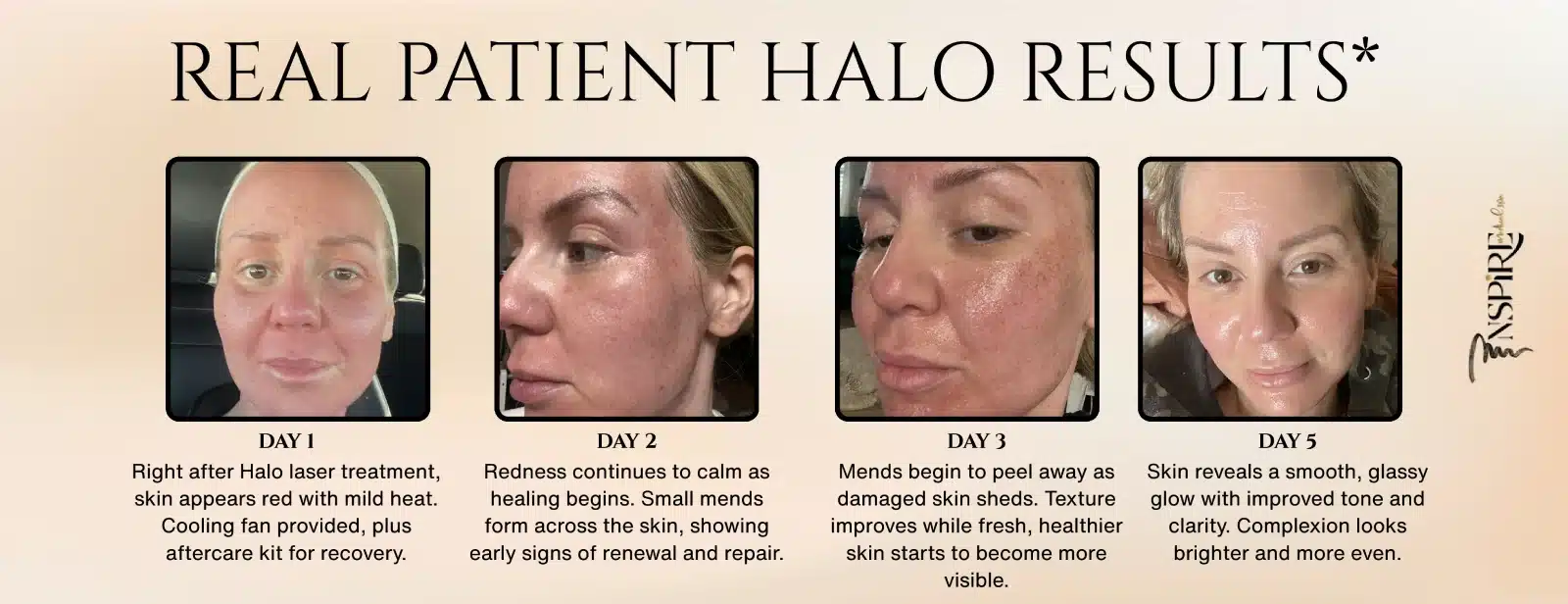 Real patient halo results from Inspire Medical Spa. Each halo result shows the days one through 5 of halo results.