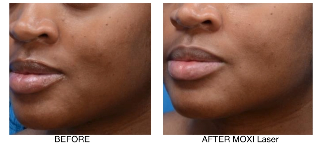 moxi-laser-before-after-results