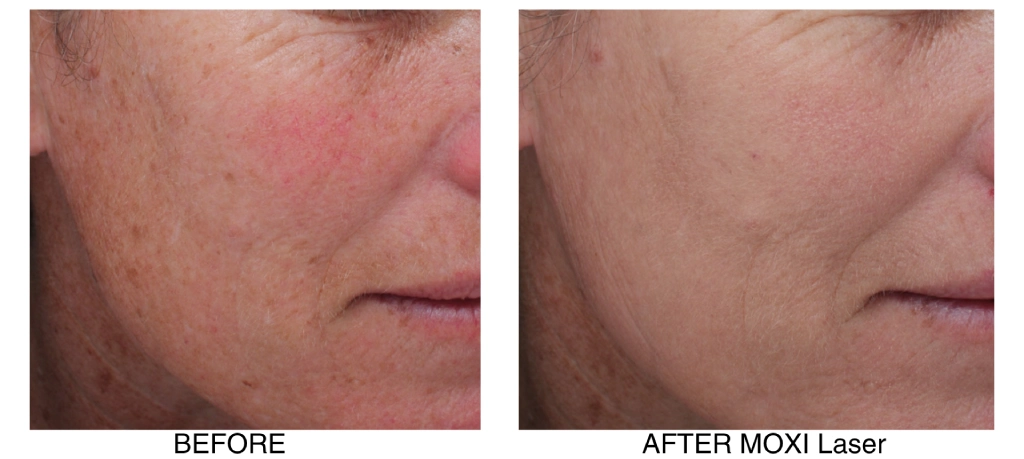 moxi-laser-before-after